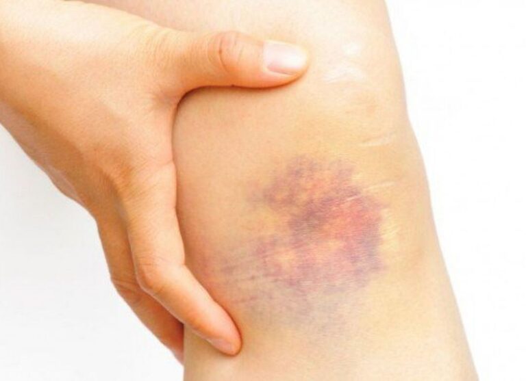 Leucemia